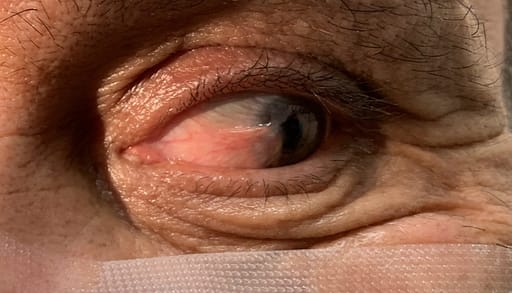 Pterygium on cornea