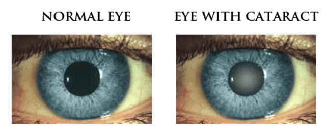 cataract surgery los angeles