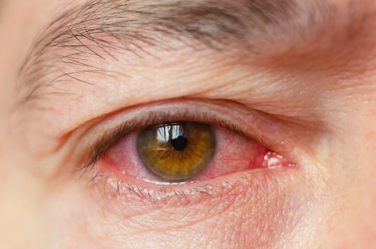 Closeup irritated infected red bloodshot eyes, conjunctivitis.