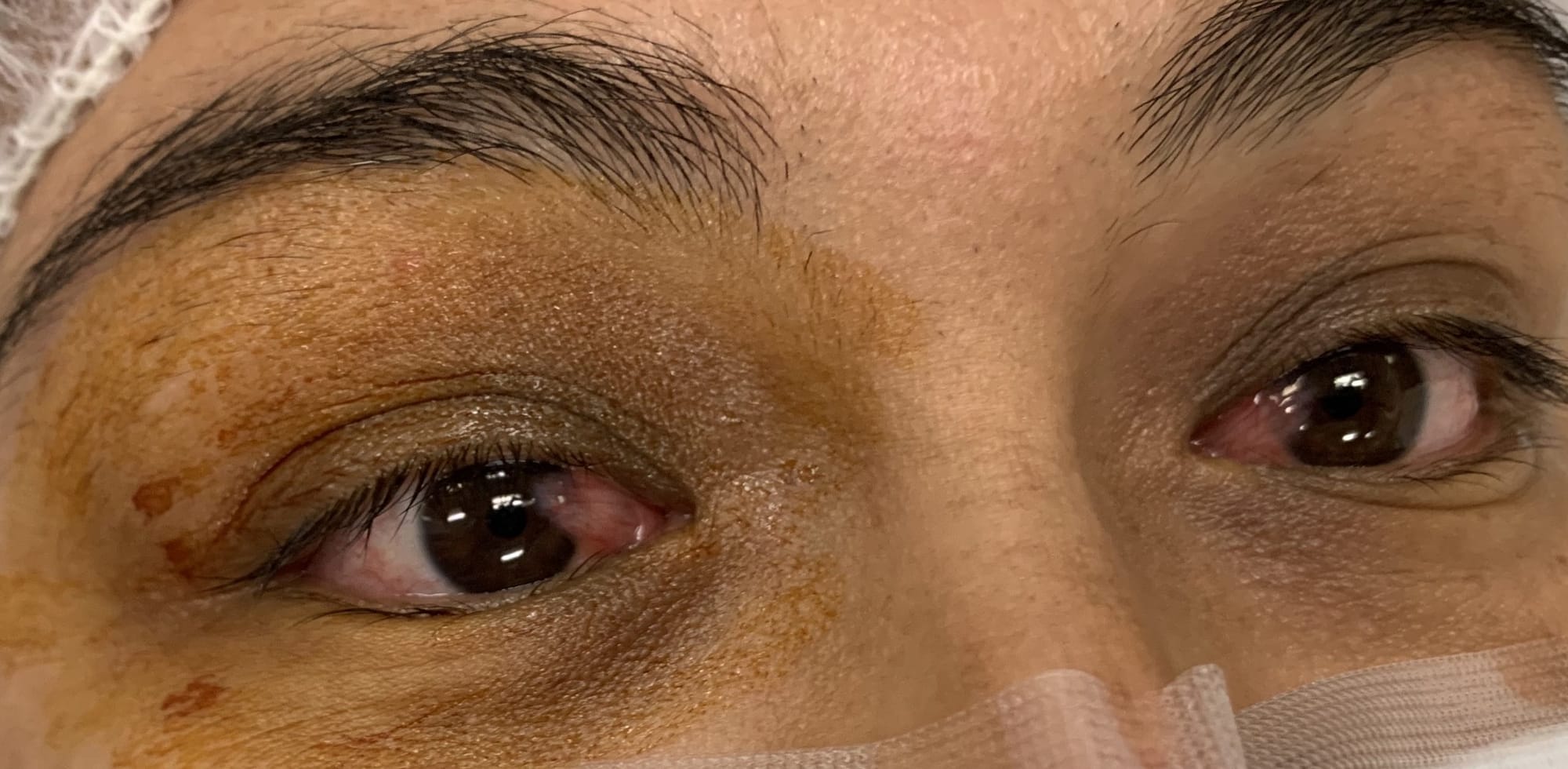 Bilateral Pterygium in a young lady being prepped for surgery
