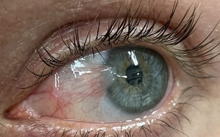 How to prevent Pterygium recurrence by performing Cosmetic Pterygium Eye Surgery 