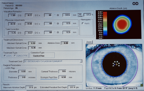 Before ICL surgery Refraction, the center of the cornea, pupil sight and Corneal Scleral margins are all detected.