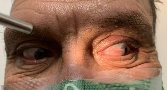 Left Eye Pterygium near pupillary zone