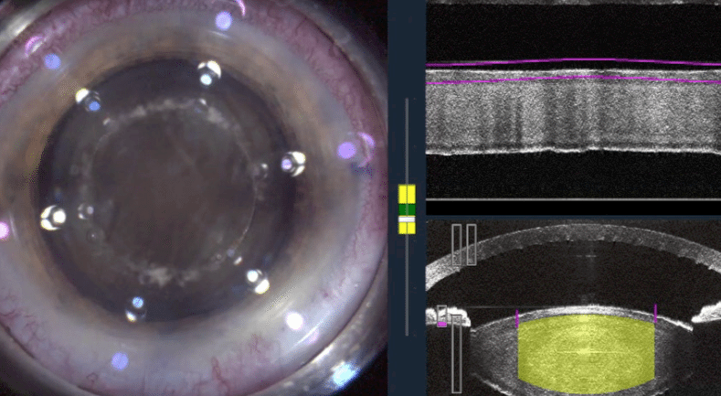 cataract-procedure-with-laser