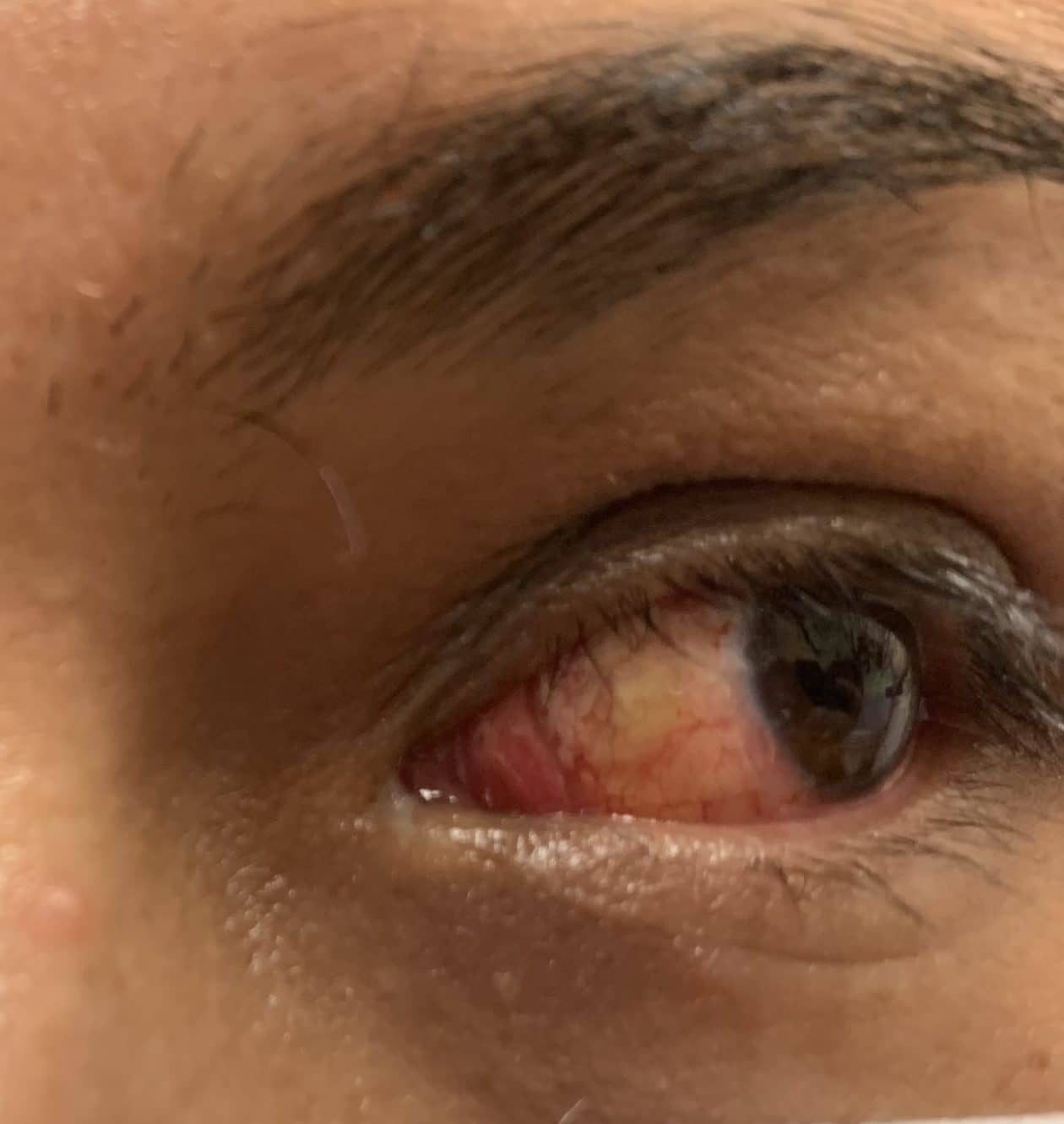 Beautiful result after surgery eye operation