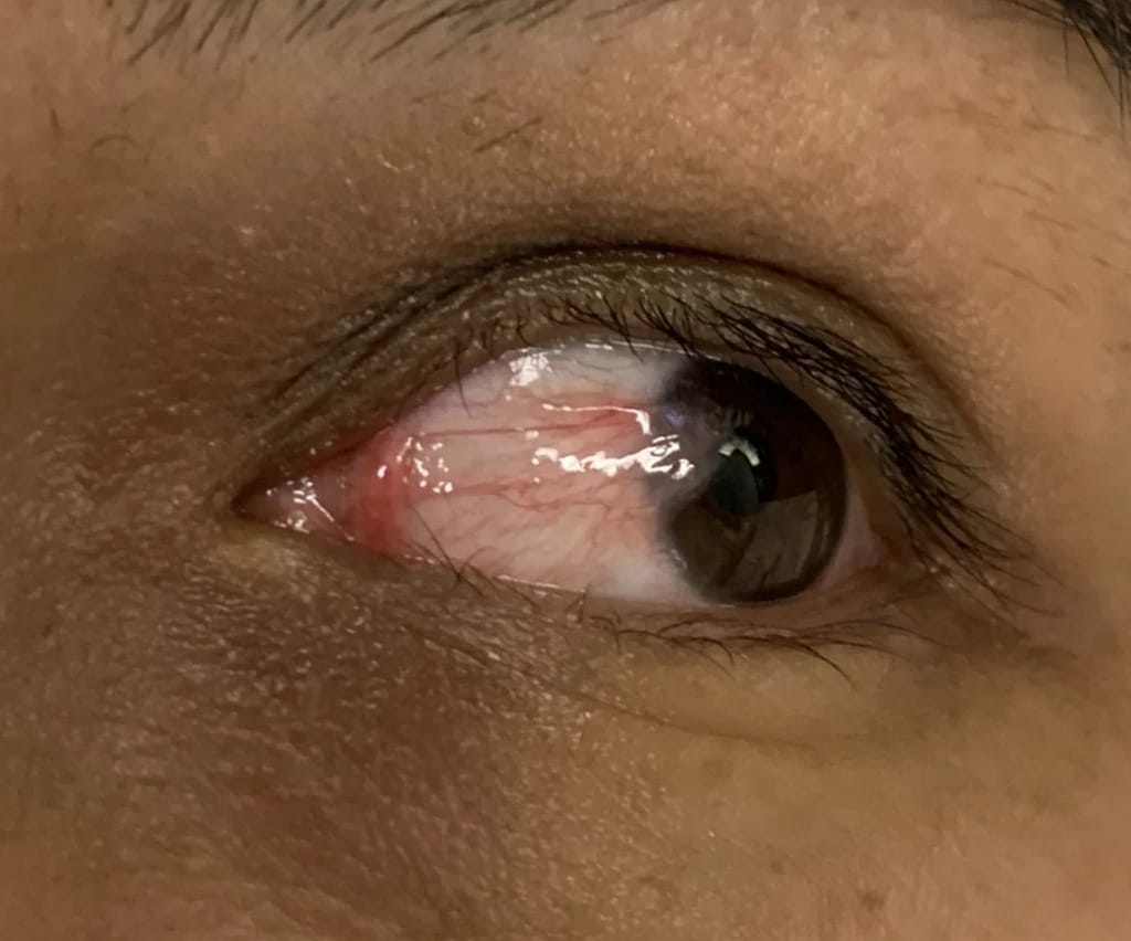 Eye before pterygium surgery