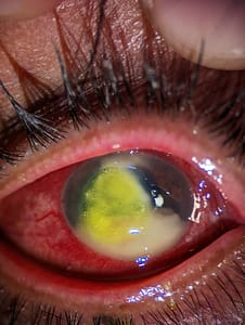 Contact lens Induced Corneal Infection Ulce