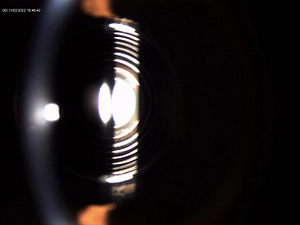 Presbyopia Lens Replacement or PIE or Presbyopias Implant in Eye