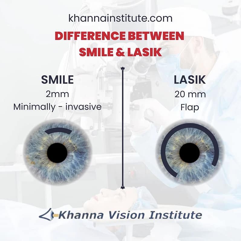 SMILE (Small Incision Lenticule Extraction) is a minimally invasive laser vision correction procedure used to treat myopia (nearsightedness) and astigmatism.