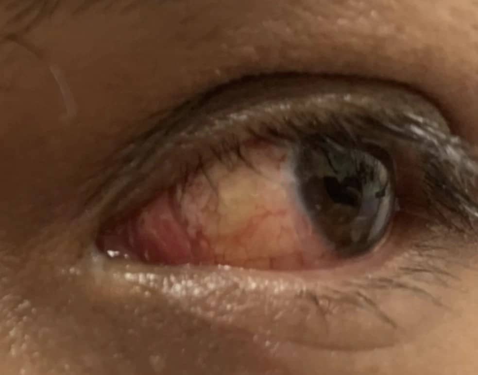 Eye after pterygium surgery