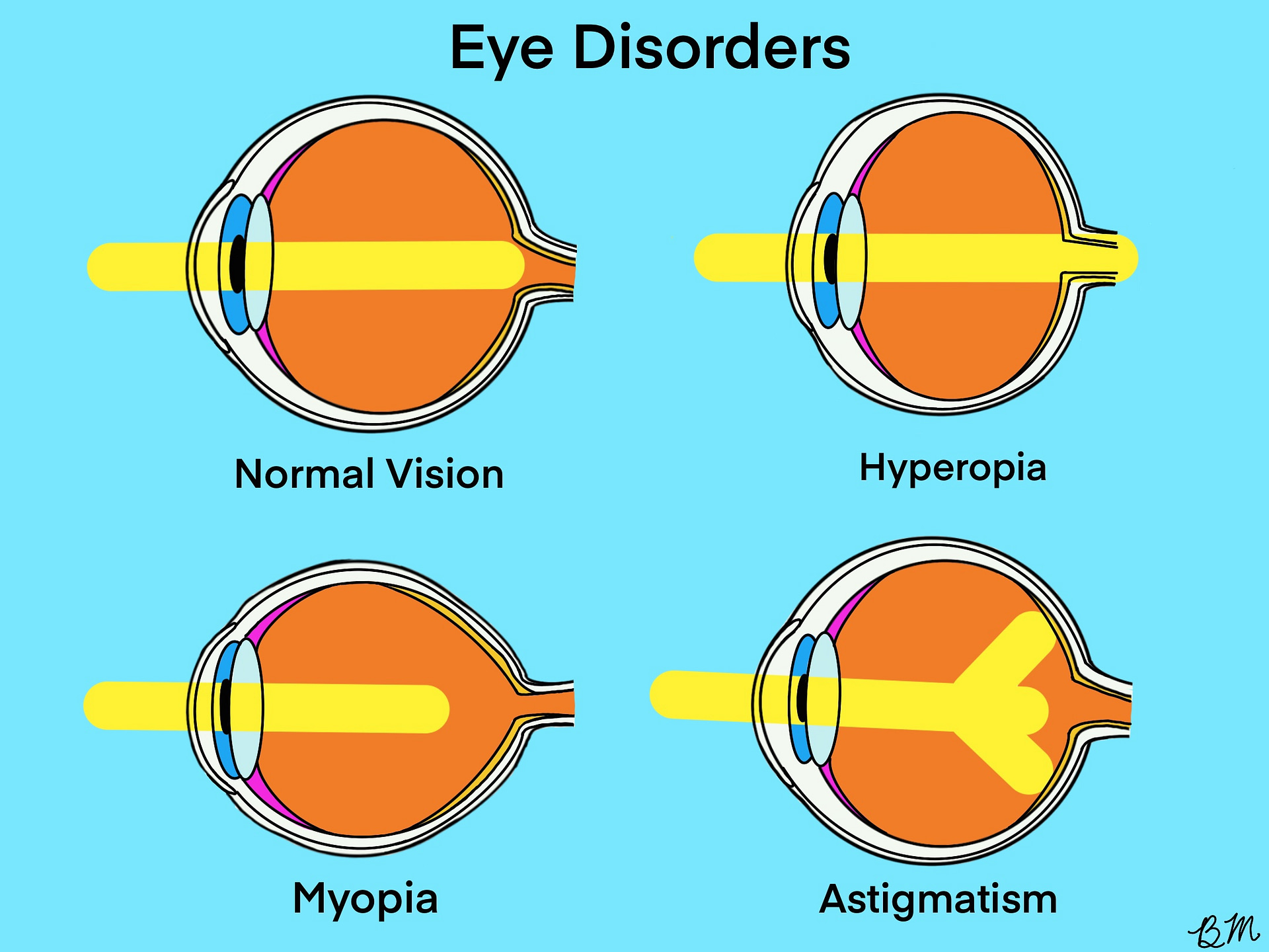 What are Myopia Hyperopia Astigmatism 
