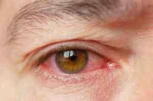 Red eye allergy